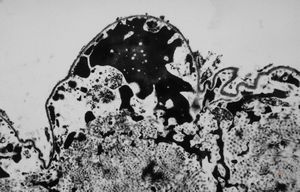 M, 63y. | cyst of choroid plexus - dystrophic calcification M, 63y. | cyst of choroid plexus - dystrophic calcification
